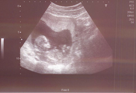 /bilder/4-Emilia-Erste-Tage/01-Ultraschall.png